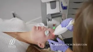 Lutronic ULTRA™ 101 with Connie Beard, Lead Medical Aesthetician | Weiler Plastic Surgery