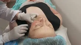 Биоревитализация при куперозе и сосудистых звездочках . Гиалуроновая кислота и витамин С.