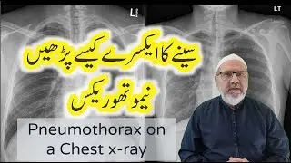 Pneumothorax on a Chest x ray || Chest x-ray interpretation in Urdu || Hindi