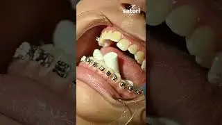 Фиксация брекетов
