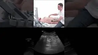 Using the Splenic Vein in #pancreas #ultrasound #shorts