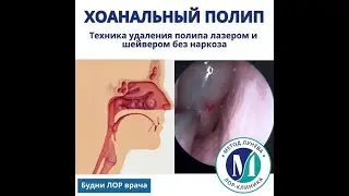 Хоанальный полип