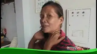 Dermazits Spray - Obat Jerawat Spray