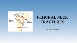 Femoral neck fracture - etiology, Garden and Pauwels classification, signs and symptoms, treatment