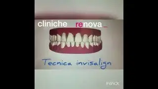 Clin check invisalign , by renova_