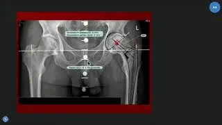 Преимущества и новые возможности TraumaCad в практике диагностической службы ортопедической клиники