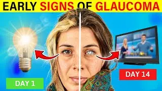 WARNING Signs Of GLAUCOMA You Should NEVER Ignore!
