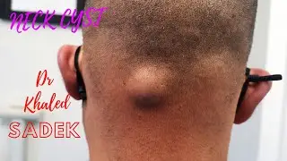 Large Pilar Cyst. Dr Khaled Sadek. LipomaCyst.com