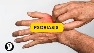 LIVET MED EN KRONISK HUDSYGDOM - PSORIASIS