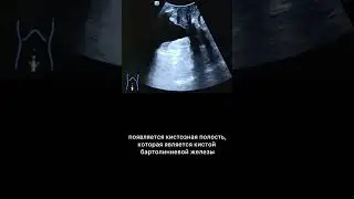 #узи #кистабартолиниевойжелезы #армдиассистент
