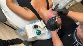 ANTEAGE EXOSOMES FOR EXTREME CO2 LASER AFTERCARE | Dr. Jason Emer