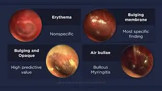 Acute Otitis Media: Otoscopic Findings