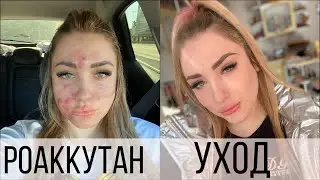 РОАККУТАН | ПОБОЧКИ | УХОД ЗА КОЖЕЙ