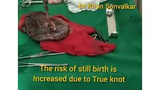 True knot of umbilical cord