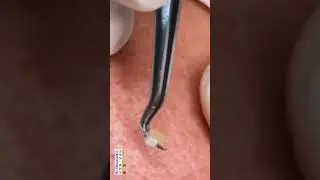 Best Satifying videos for Relaxation with Rat Tana Acne Spa