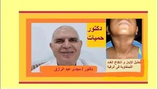 تحليل الإيدز و أنتفاخ الغدد الليمفاوية فى الرقبة |  HIV test