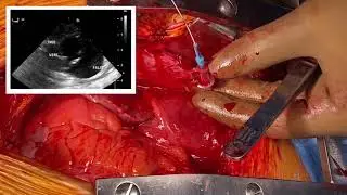 Surgical Management of Type A Aortic Dissection