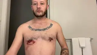 FTM Update - Top surgery revision (round 2) with Dr Gallagher