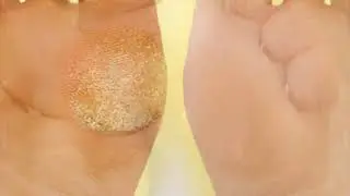 Как избавиться от натоптышей