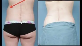 Repair of flank hernias
