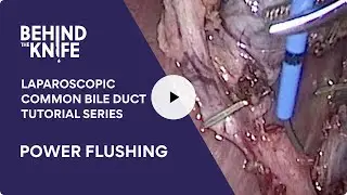Power Flushing | Laparoscopic Common Bile Duct Tutorial Series: Ep. 3