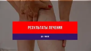 Лазерное лечение варикоза. Результаты работ флеболога Семенов А.Ю.