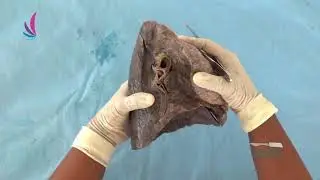 Thorax Part-02 Left lung