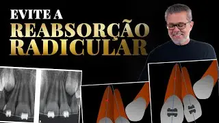 Domine a Colagem de Bráquetes 4x2 😁