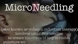 Dftv microneedling