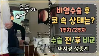 비중격만곡증 비염수술 생생후기ㅣ수술전,수술후 비교 및 1주차,2주차 코속 상태, 치료과정 (Feat.구독자)