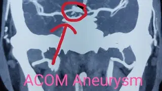 intrapharnchymal bleed with Sub arachnoid hemorrhage