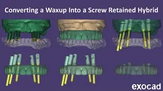 Converting a Waxup to a Hybrid in Exocad