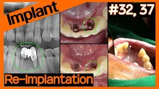 [Online Surgery] Re-implant on failed MS implant site using OneMS