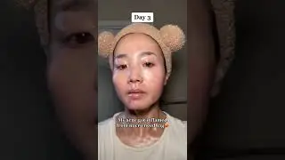 Vampire facial honest review🧛‍♀️