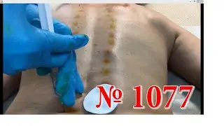 №1077 Метод RANC двигательные расстройства и боль в суставах 