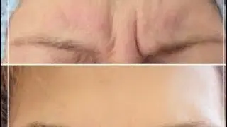 3-дарс. 2 кош уртасидаги ажинни ёкотиш.