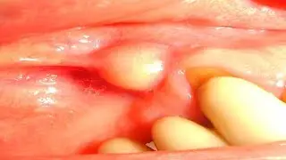 Absceso Dental Tratamiento 🙏 Como Drenar Un Absceso Dental En Casa