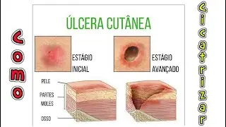 Como Curar Úlceras na Pele - Ferida Tipo Pequena Úlcera na Pele Como Fazer Cicatrizar
