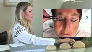 Cirurgia de Pálpebras