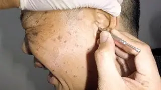 Elderly Man's Massive Earwax Removal