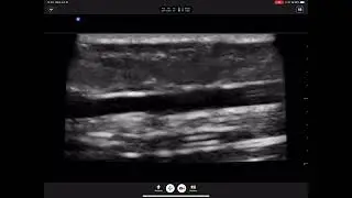 1   venospasm from hard flush