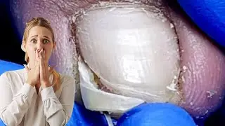 🔥 You will never have fungus on your nails again! 100% natural remedy for toenail fungus