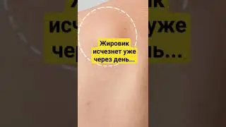 Жировик лечение в домашних условиях 