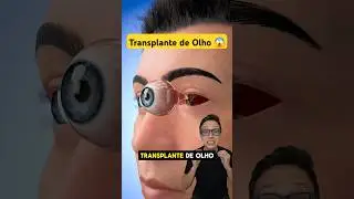 Transplante de Olho 😱