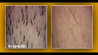 Koltuk Altı Lazer Epilasyon
