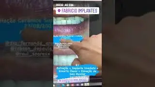 Implantes e Levantamento de Seio! O que é levantamento de seio?!