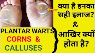 Plantar warts, Corns & Calluses -Causes, Symptoms & Treatment