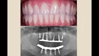 retroceso a fase 2 en odontología
