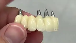 Implantátové korunky v JS Lab
