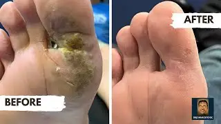 Treatments for Plantar Warts